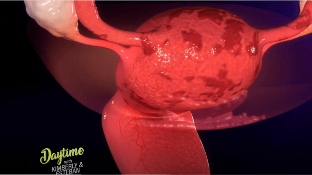 Daytime-It's National Endometriosis Month