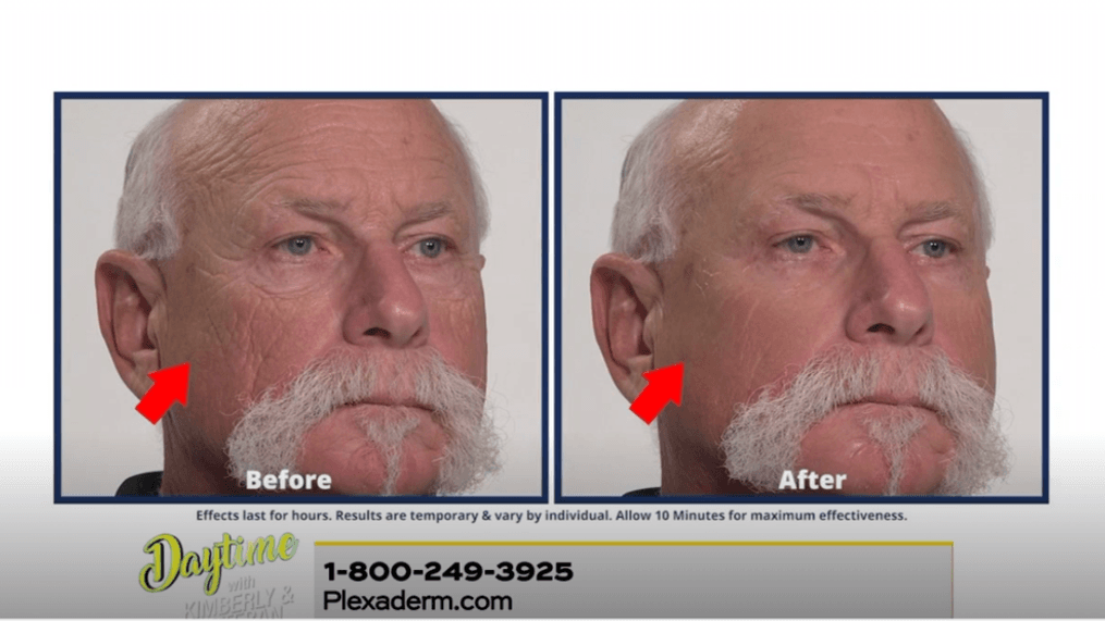 Erase your wrinkles with Plexaderm