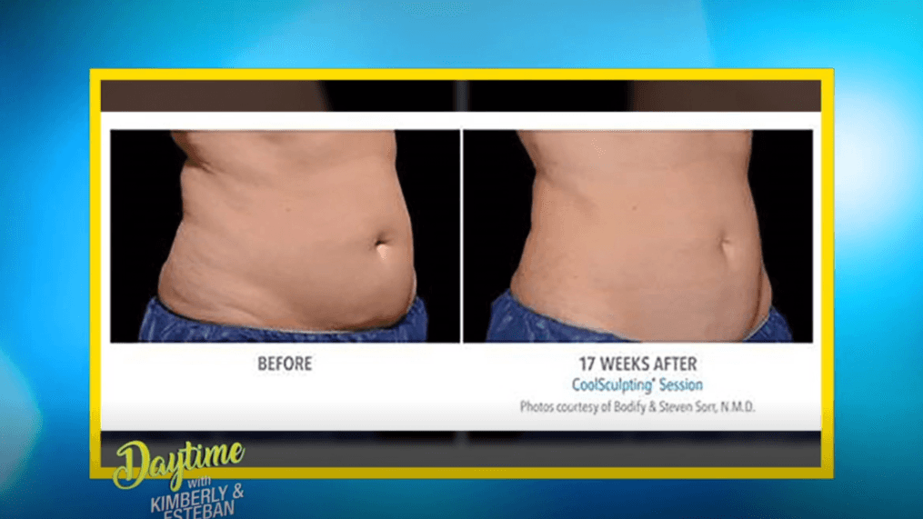 DAYTIME - Freeze Away Unwanted Fat