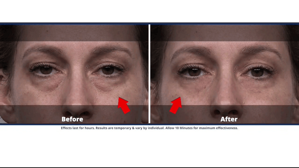 Plexaderm