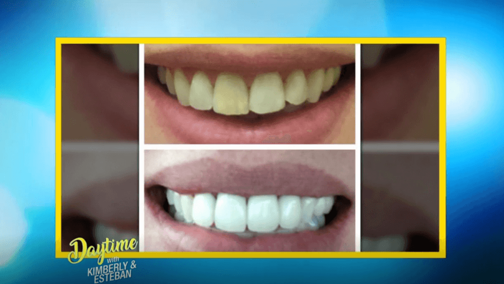 DAYTIME-How to get a million-dollar smile 