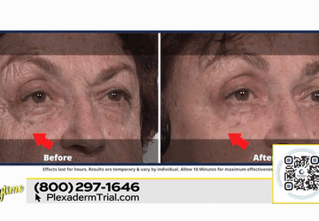 Image for story: Look & Feel Younger with Plexaderm